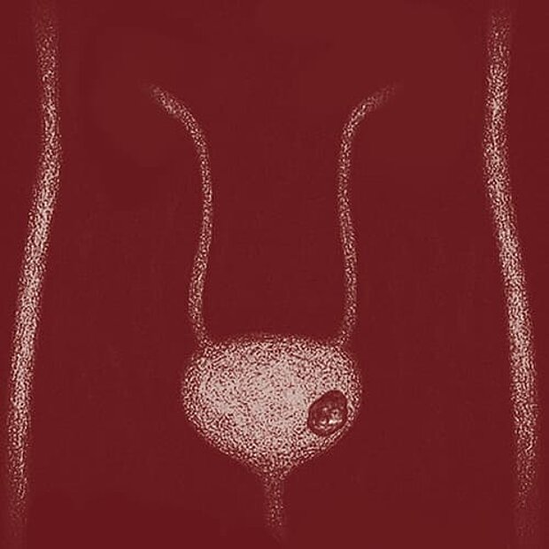 Grafik zum Thema Harnblasenkrebs