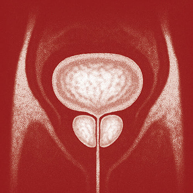 Grafik zum Thema Prostataverkleinerungsoperation