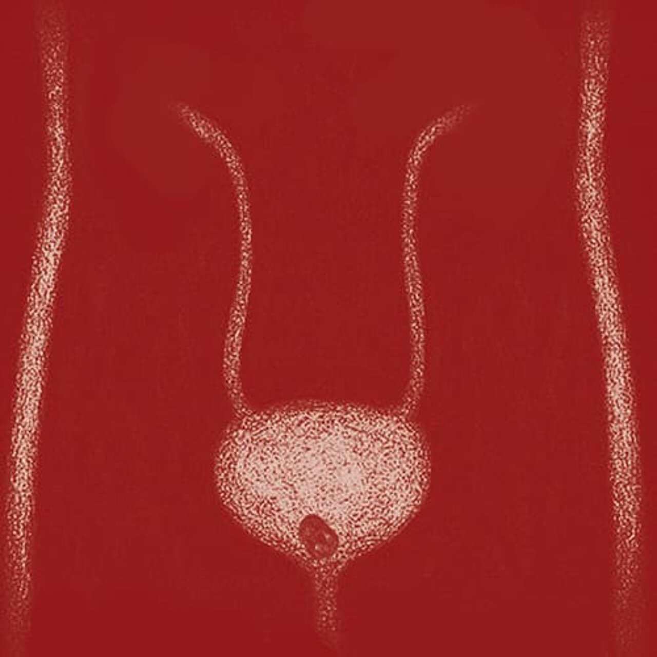 Grafik zum Thema Harnblasenstein