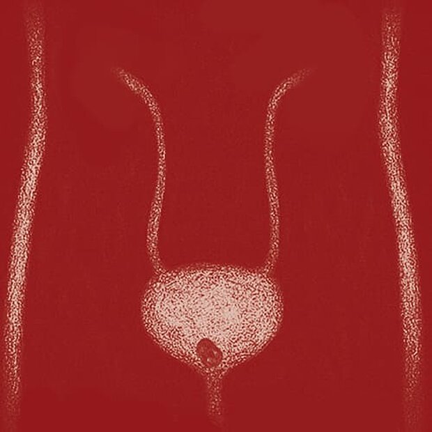 Grafik zum Thema Harnblasenstein