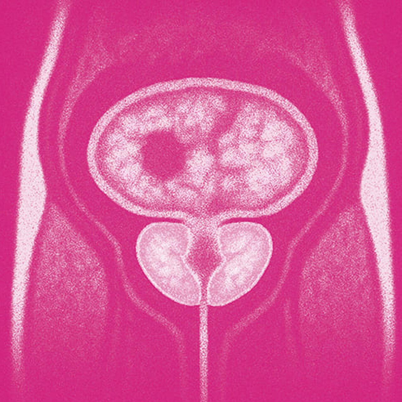 Grafik zum Thema Prostatakrebs
