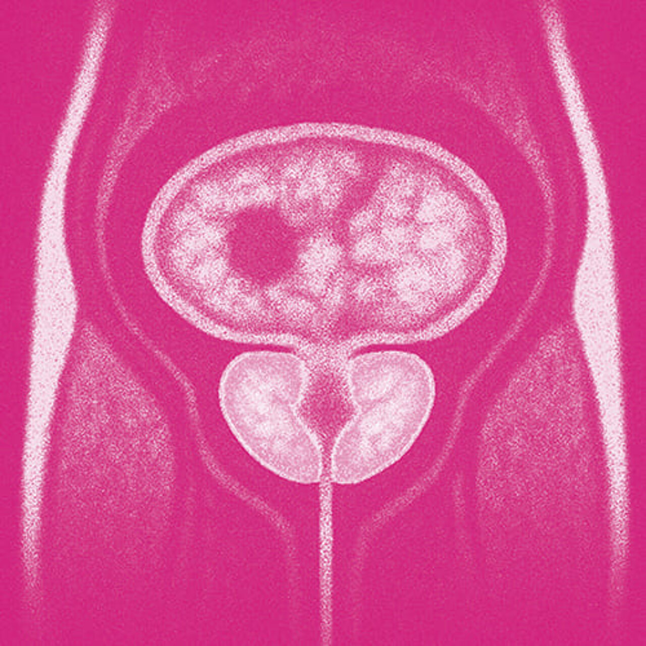 Grafik zum Thema Prostatakrebs