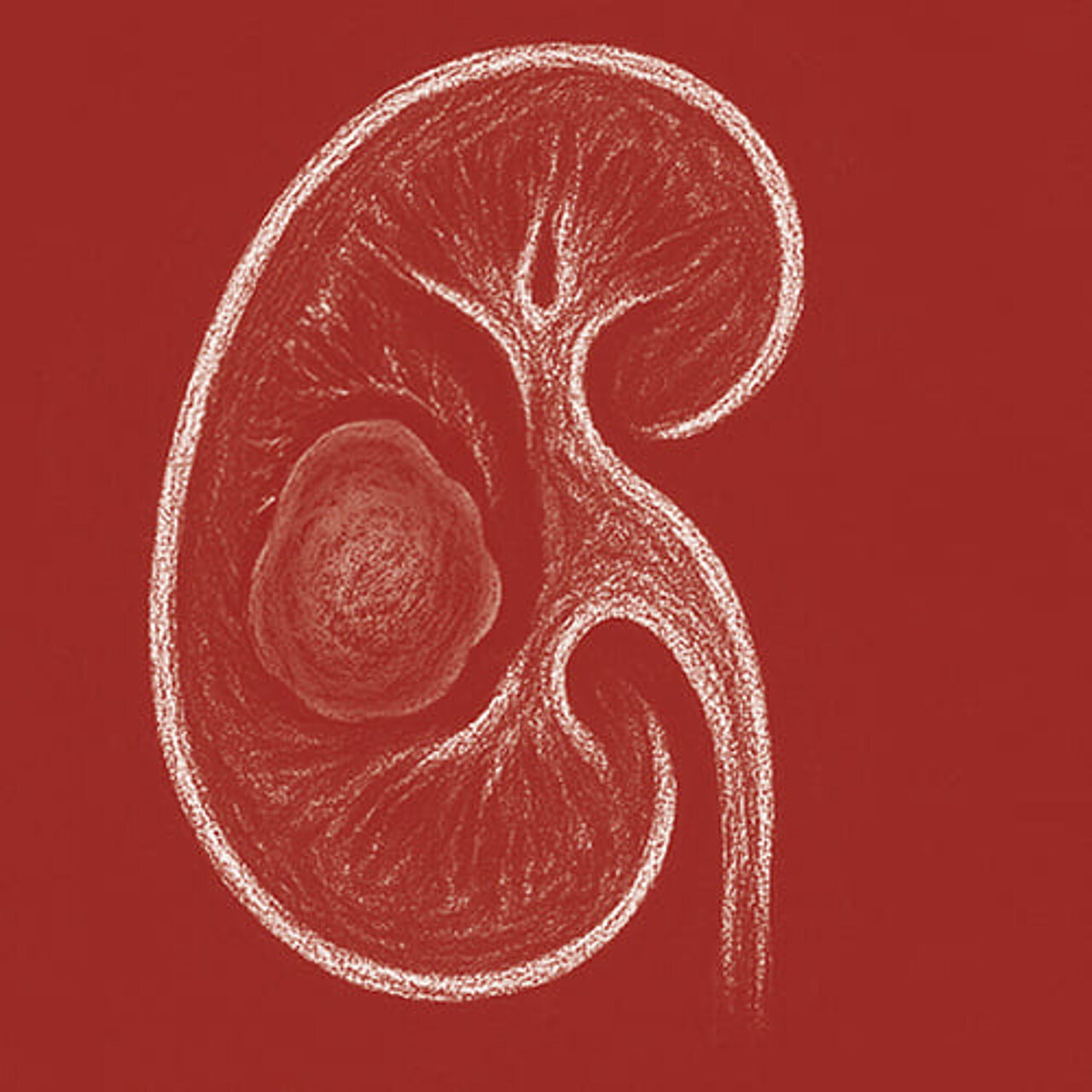 Grafik zum Thema Nierenzysten