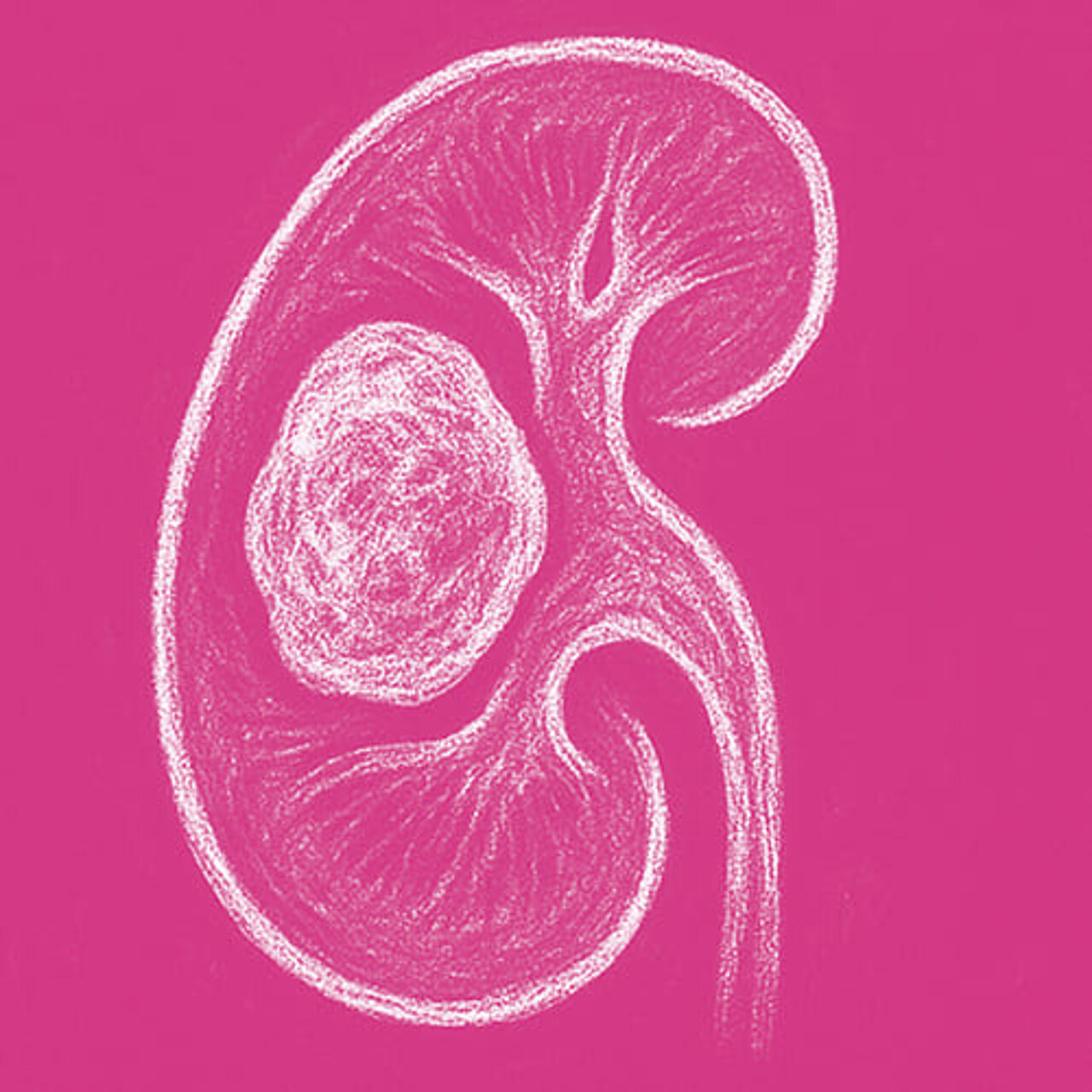 Grafik zum Thema Nierentumor