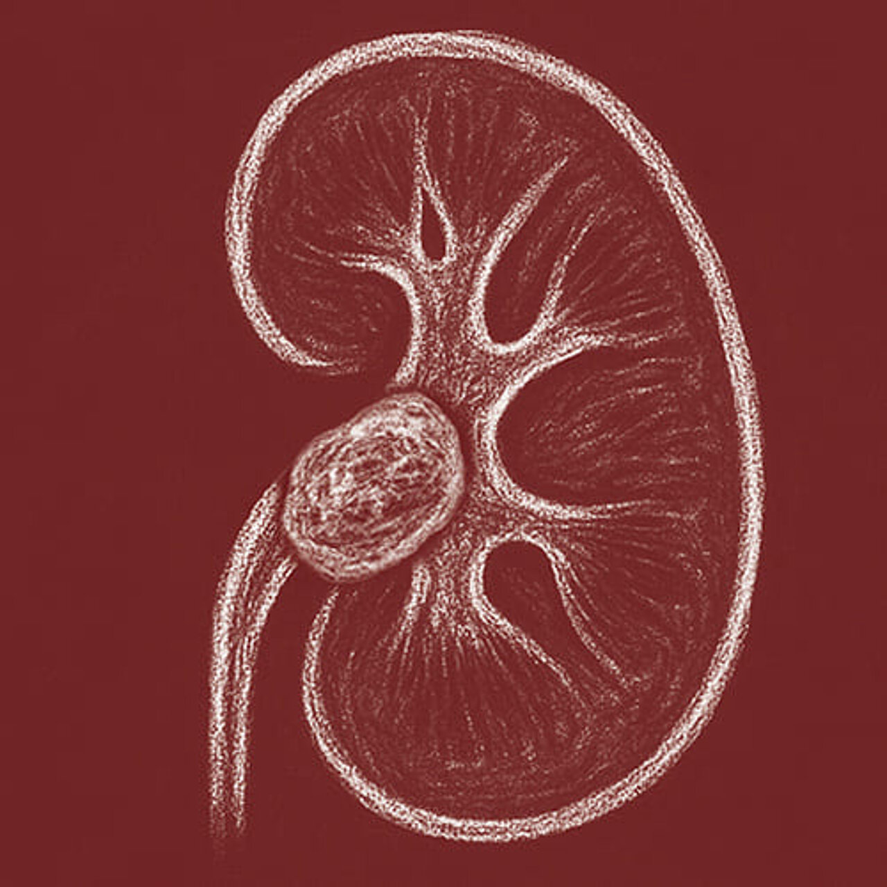 Grafik zum Thema Nierenbeckenkrebs