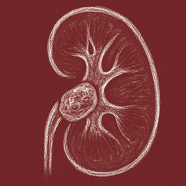 Grafik zum Thema Nierenbeckenkrebs