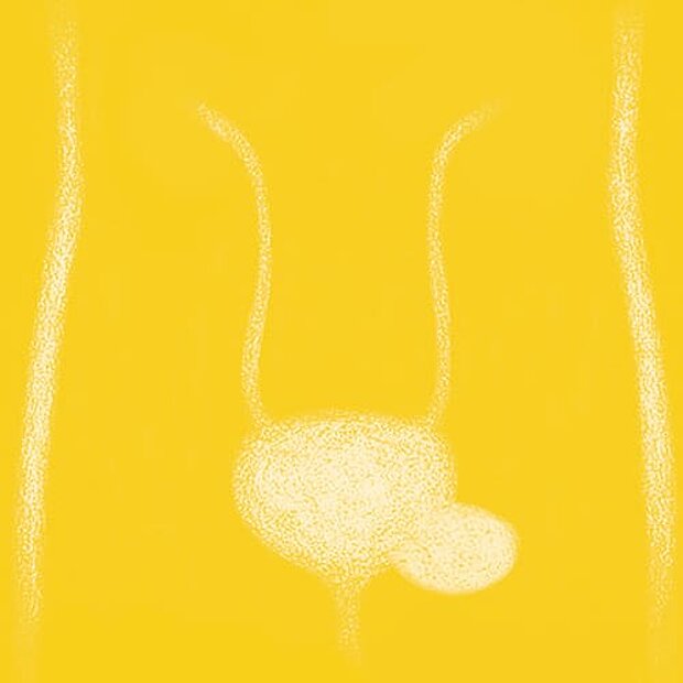 Grafik zum Thema Harnblasendivertikel