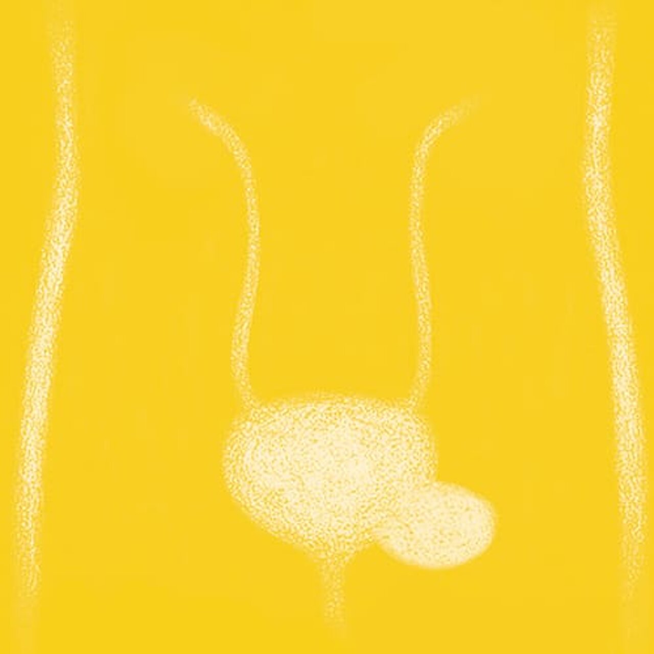 Grafik zum Thema Harnblasendivertikel