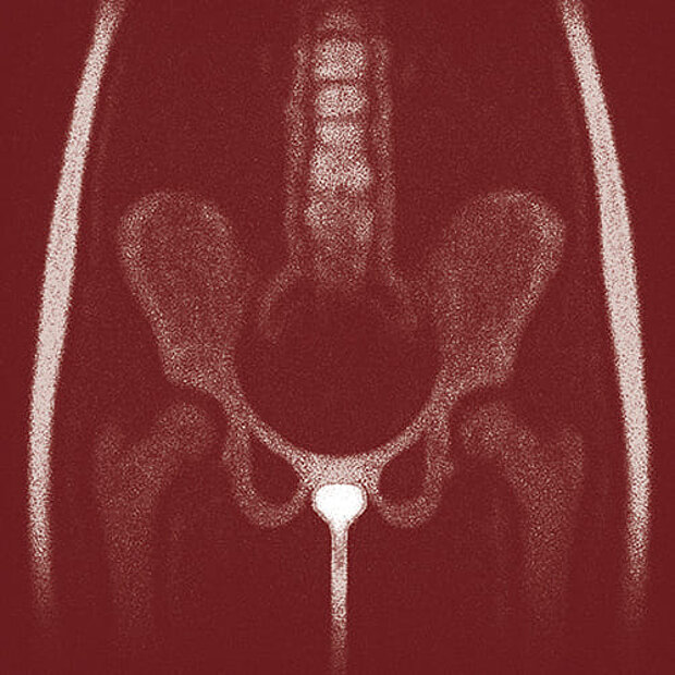 Grafik zum Thema Schließmuskelschäden beim Mann