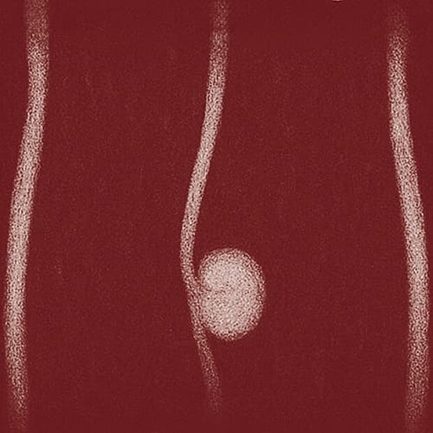 Grafik zum Thema Harnleitertumor