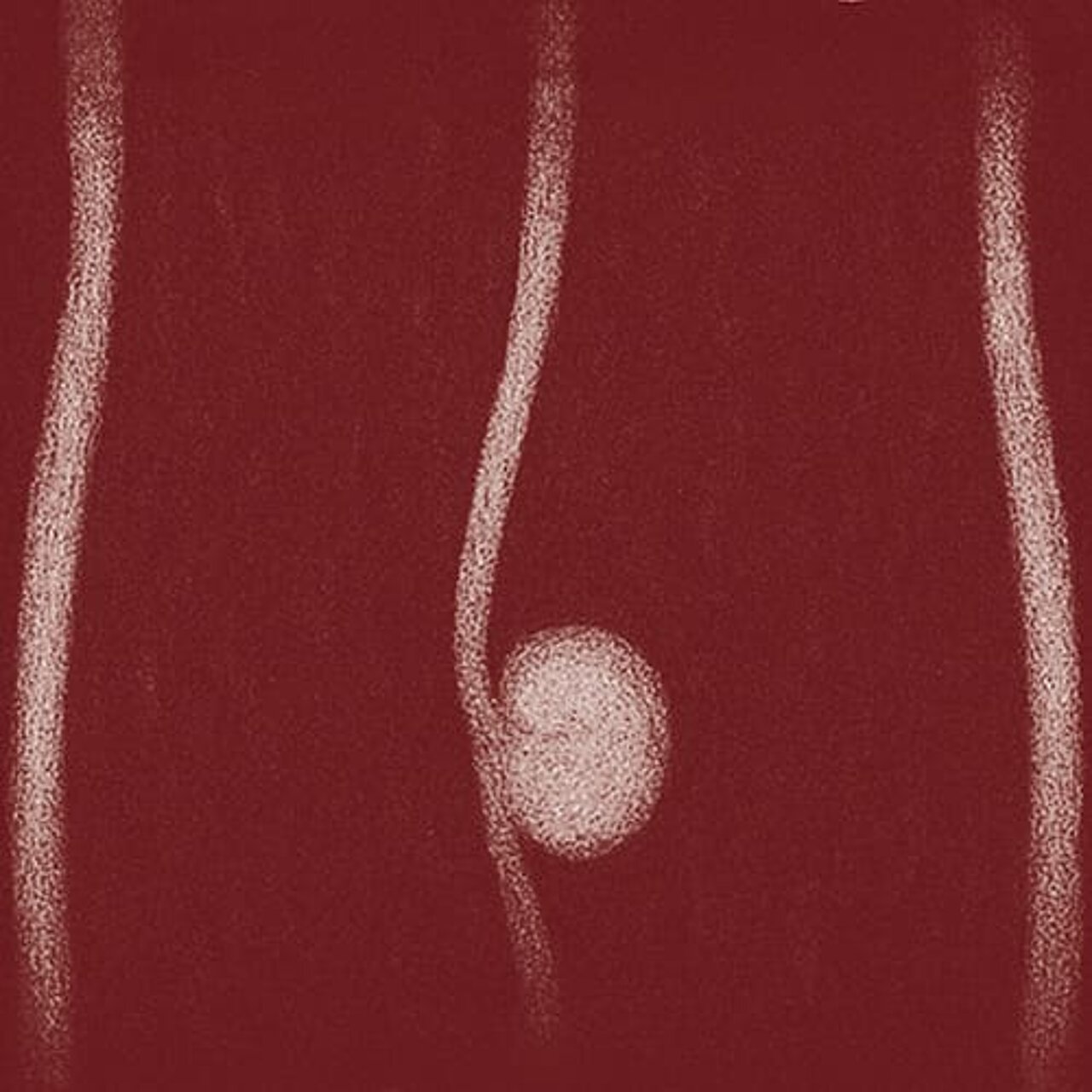 Grafik zum Thema Harnleitertumor