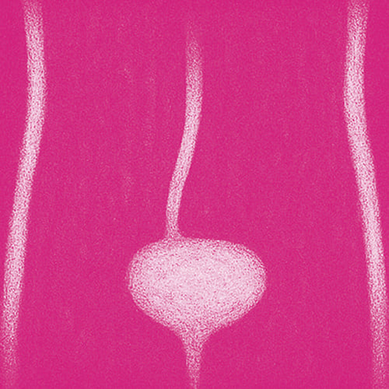 Grafik zum Thema Harnleiterenge