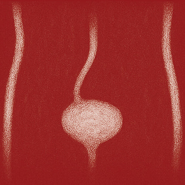 Grafik zum Thema Nierenabgangsenge