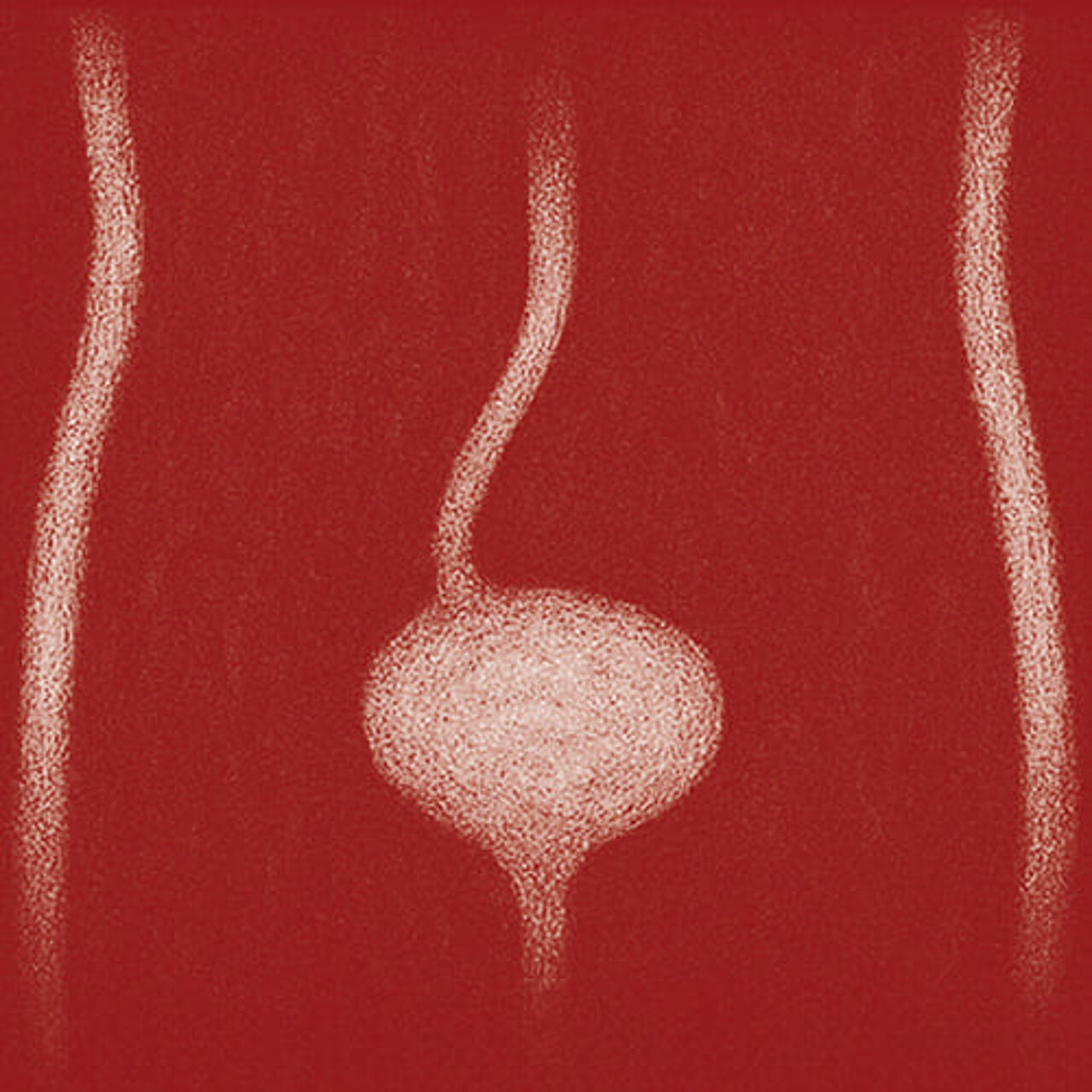 Grafik zum Thema Nierenabgangsenge